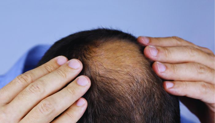 guys with hair loss problem