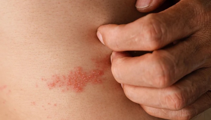 What is the Best Anti-Itch Cream for Shingles