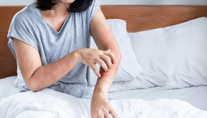 What is the Best Anti-Itch Cream for Shingles