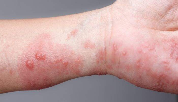 what is shingles 